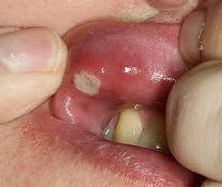 canker sore on tongue gum mouth