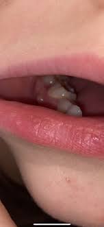 The symptoms of gum infection include: What S This On My Sons Gum Pics Mumsnet