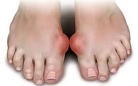Image result for gout diseases causes, symptoms & treatments