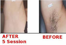 permanent laser hair removal in 51000
