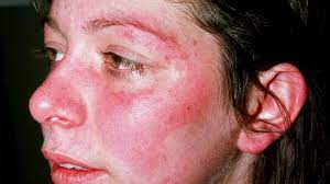 erfly rash causes symptoms