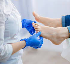 onychocryptosis or ingrown toe nail