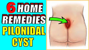 pilonidal cyst or pilonidal abscess
