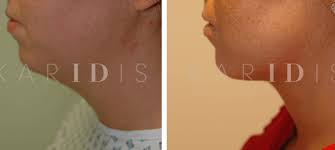 We did not find results for: Liposuction Before After Results Uk Karidis