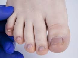 fungal nail treatment adelaide north