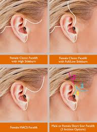 Home/face procedures/ facelift and neck lift. Facelift Toronto Facial Rejuvenation Specialist Dr Marc Dupere