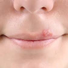 cold sores how to get rid of cold