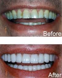 what color should your veneers be