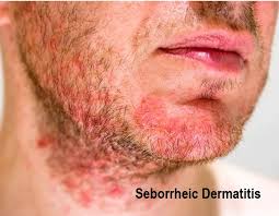learn about seborrheic dermais and