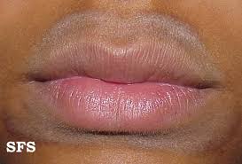 rash around mouth lips causes