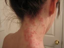 skin rash celiac disease gluten free