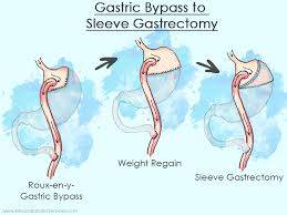 16 revision bariatric surgery in mexico