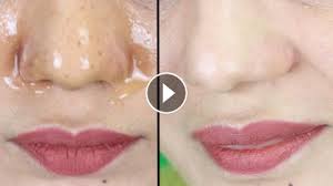 These tips will help you get rid of whiteheads on the nose fast. Easiest Way To Remove Blackheads Whiteheads In Some Minutes Remove Blackheads From Your Nose