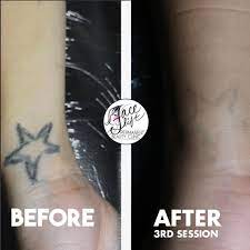 best laser tattoo removal in kolkata
