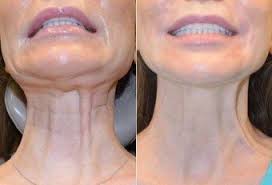 Image result for botox treatment before and after