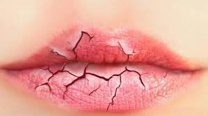 chapped lips causes prevention and