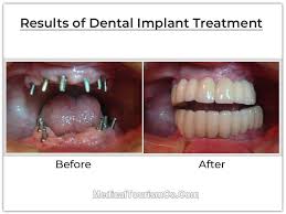 We did not find results for: Dental Implants In Mexico Low Cost Full Mouth Implants