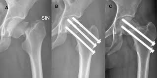 displaced stress fracture of the