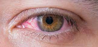 symptoms of red eye and how to prevent