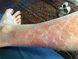 why hiker s rash happens and how to