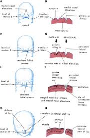 cleft lip and palate sciencedirect