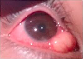 sterile subconjunctival abscess in an