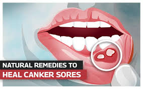 heal canker sores mouth ulcers