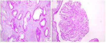 Thin Basement Membrane Disease