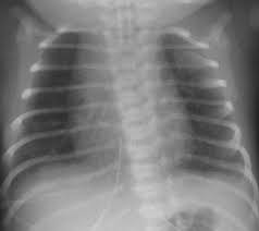 Chests are interactibles that are scattered throughout every environment (excluding the bazaar between time , a moment, fractured , a moment, whole , and the void fields ) at random. Lung Disease In Premature Neonates Radiologic Pathologic Correlation Radiographics
