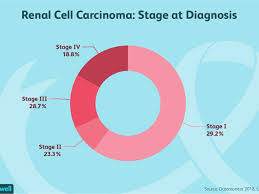 Renal Cell Carcinoma Symptoms Causes Diagnosis And Treatment