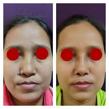 rhinoplasty cost in india nose job