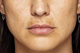 what is a melasma mustache and how do i
