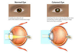 of cataracts
