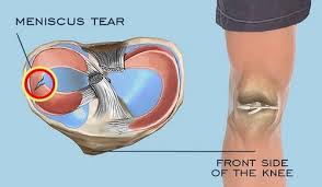 meniscus tear surgery at best in