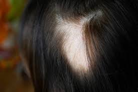 hair loss and thinning hair in women
