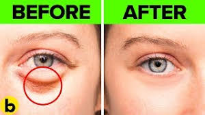 remes to get rid of under eye bags