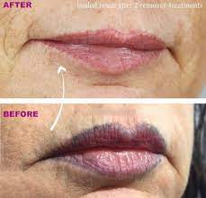 lip tattoo removal all about laser