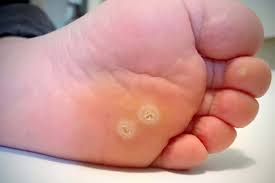 how to get rid of plantar warts