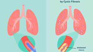 Cystic Fibrosis Symptoms Causes Diagnosis Treatment And