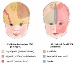 sturge weber syndrome an updated