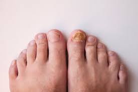 toenail fungus signs symptoms and