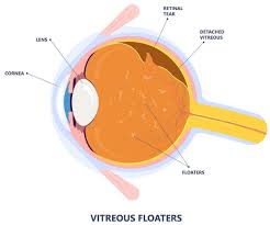 floaters treatments at boulder eye surgeons