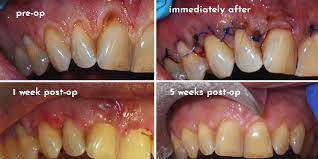 periodontal plastic surgery soft tissue