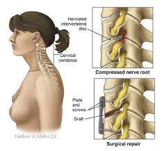 herniated disc cervical acdf slipped
