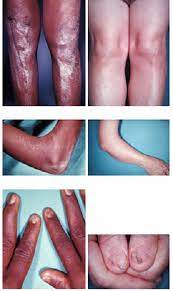 nail patella syndrome symptoms
