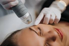 microneedling for acne scars how does