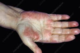 Palmar erythema is a reddening of the palms that can occur for several reasons, but it can also occur for no reason at all. Palmar Erythema Keyword Search Science Photo Library