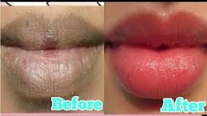 smoker s lips causes signs and treatment