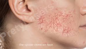 how to get rid of spider veins on face
