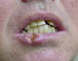 squamous cell carcinoma lower lip cancer